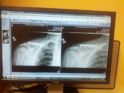 Collarbone Bar Xray4.jpg