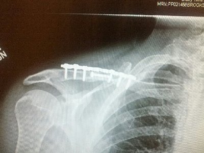 Collarbone Bar Xray2.jpg