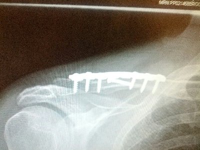 Collarbone Bar Xray.jpg